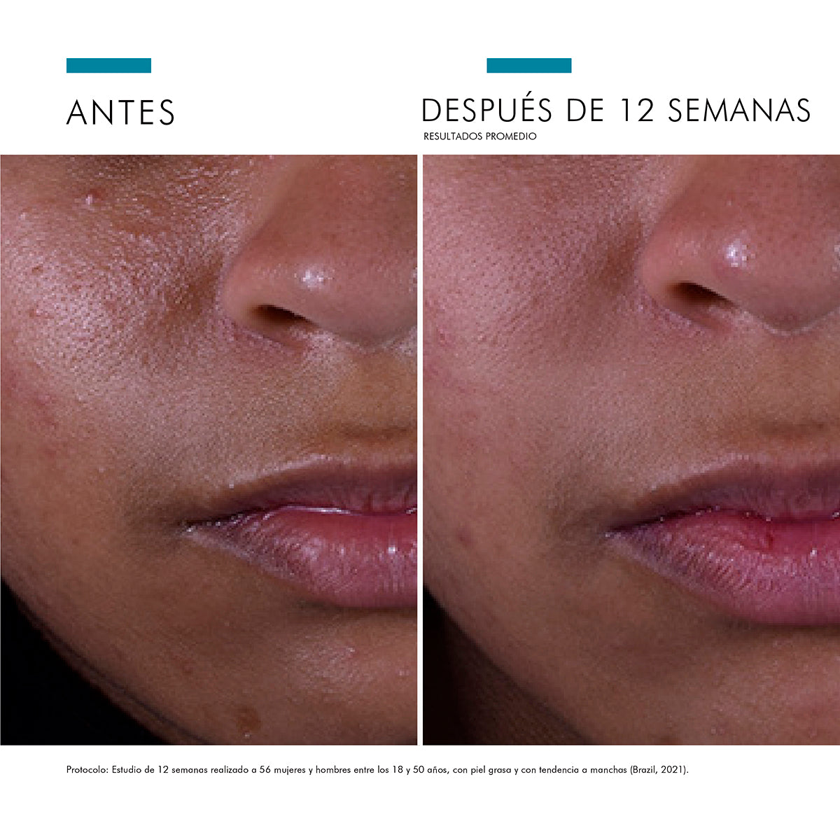 Pack Acné Tardío Skinceuticals Sérum Antioxidante Silymarin CF y Blemish and Age Collection Size